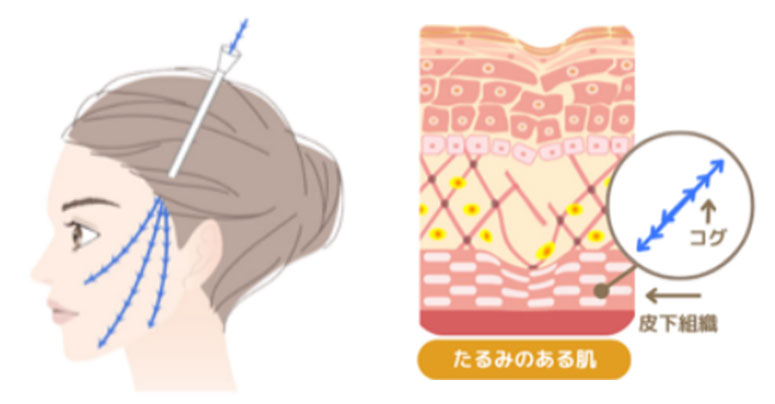 糸リフトイメージ