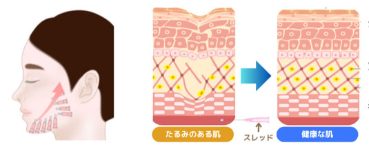ショートスレッドイメージ