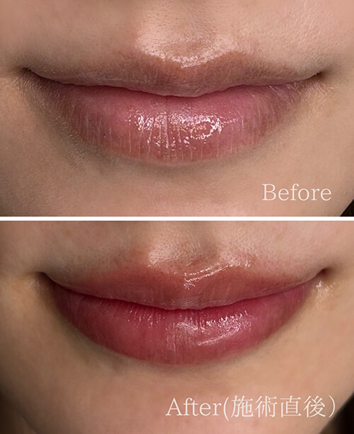 リップ ビフォーアフター画像1
