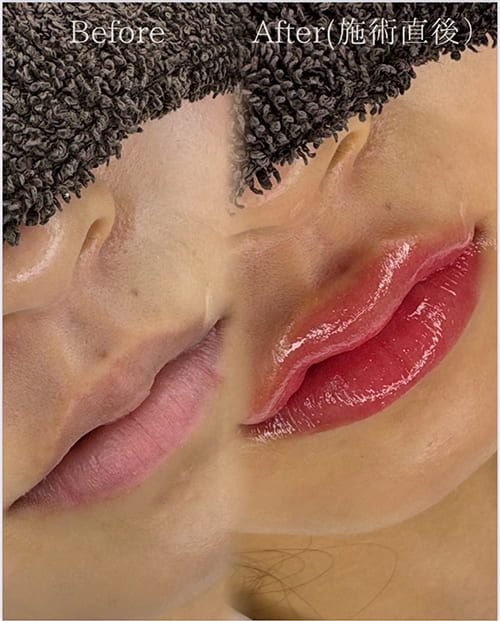 リップ ビフォーアフター画像3