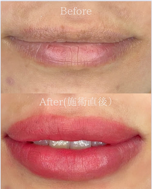 リップ ビフォーアフター画像4