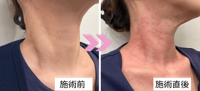 スキンタッグ・軟性繊維腫 治療前と治療直後