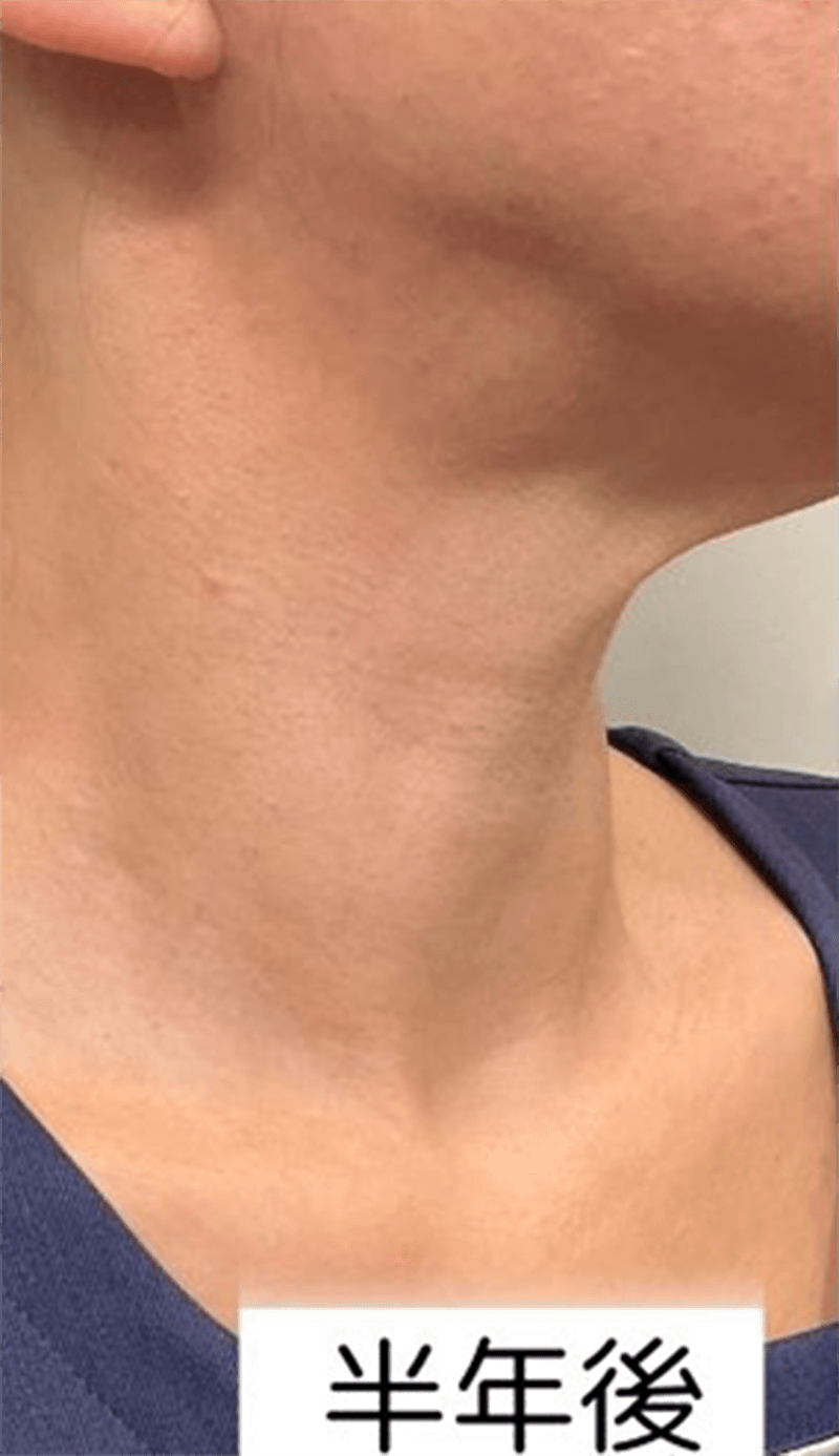 スキンタッグ・軟性繊維腫 半年後