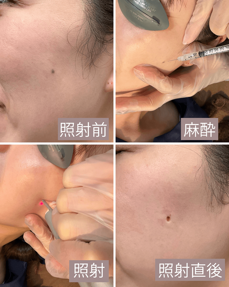 色素性母斑（ほくろ）の経過1