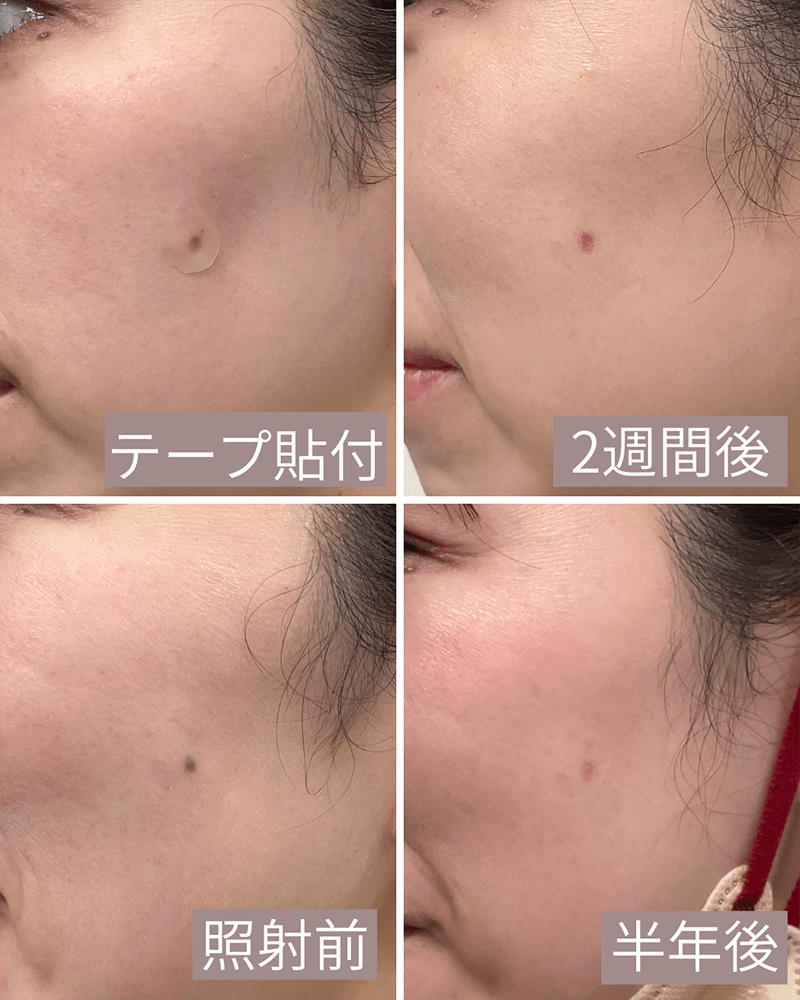 色素性母斑（ほくろ）の経過2