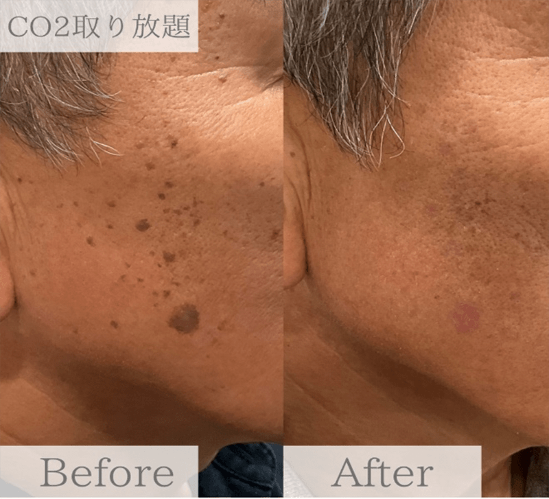炭酸ガスレーザー　顔取り放題