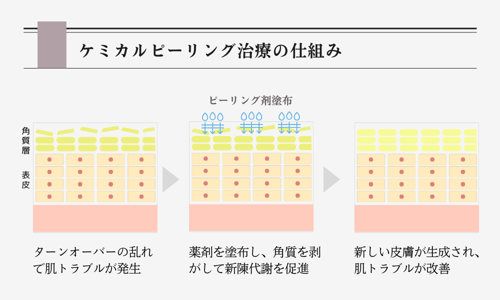 ケミカルピーリング